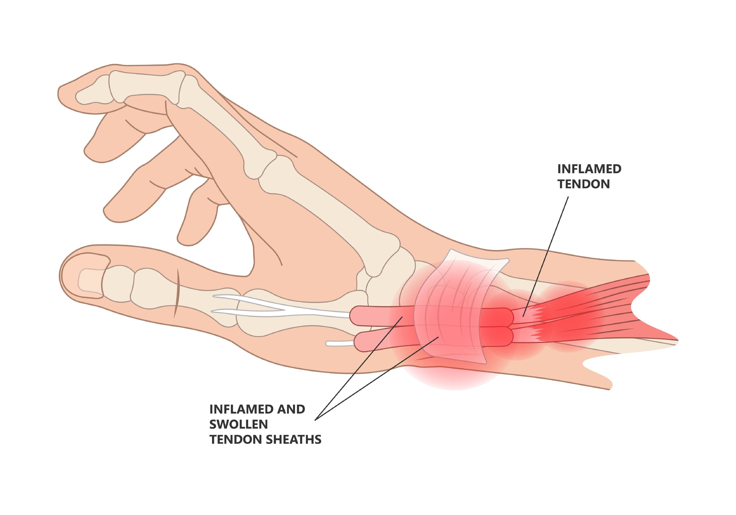 3 Common Causes of Hand Pain Without Injury