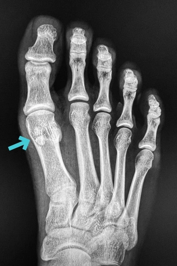 Pain under your Big Toe or Ball of the Foot? Learn about Sesamoid