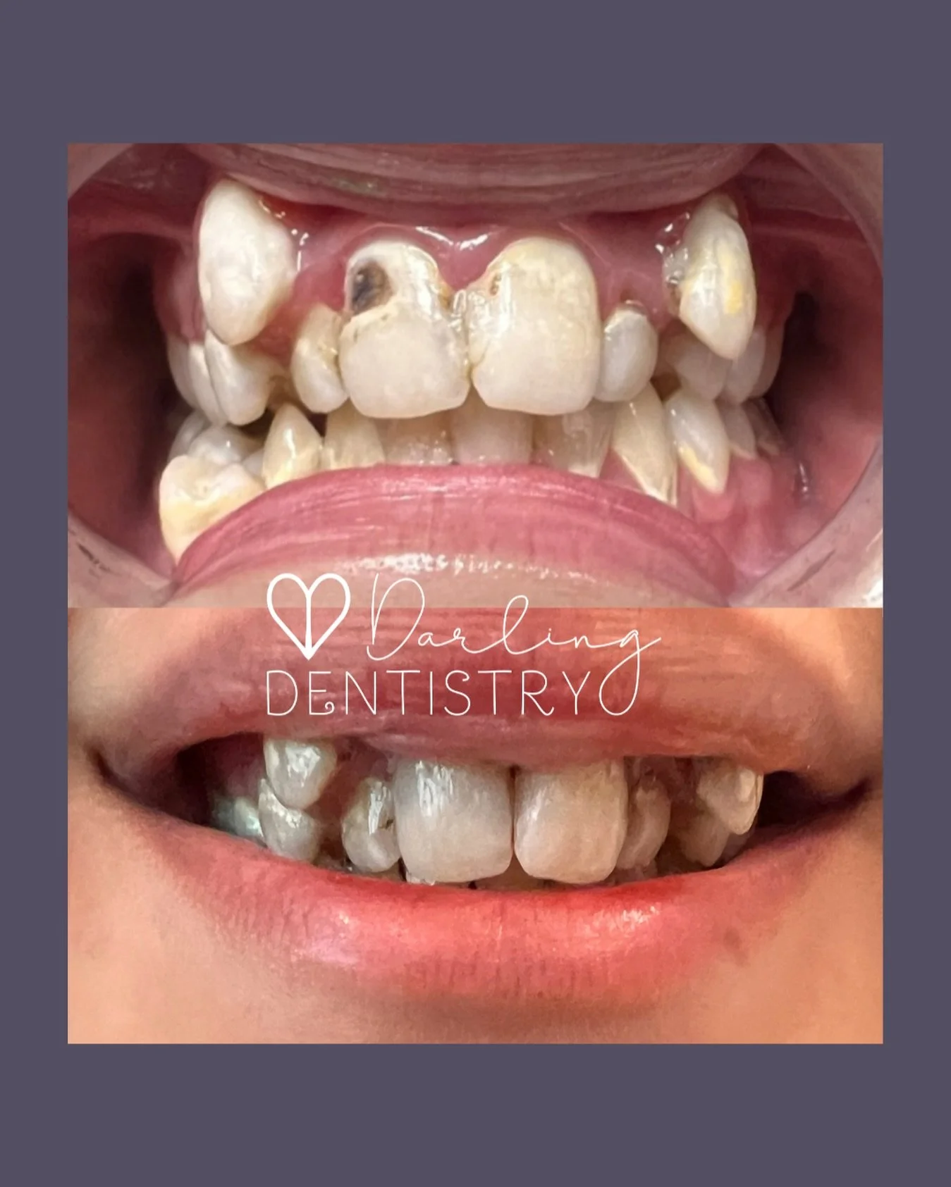 Have you ever felt overwhelmed, embarrassed, or afraid about going to the dentist? ✋🏼
You&rsquo;re far from alone. And for these reasons sometimes people delay care, and it gets more and more overwhelming. 😓
But 1. It&rsquo;ll never be less (treatm