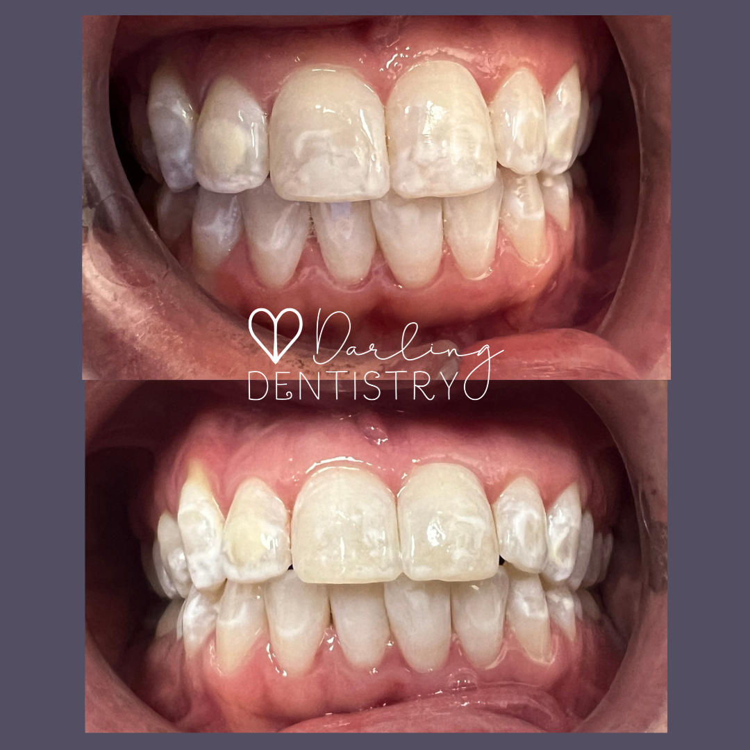 Transformations Gallery Darling Dentistry contact-us-dear-darling-mayfair