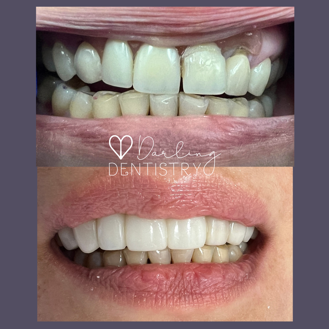 Transformations Gallery Darling Dentistry transformations-gallery-darling-dentistry