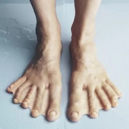 A pair of elderly feet with enlarged and deformed toes, resting on a light-colored surface.