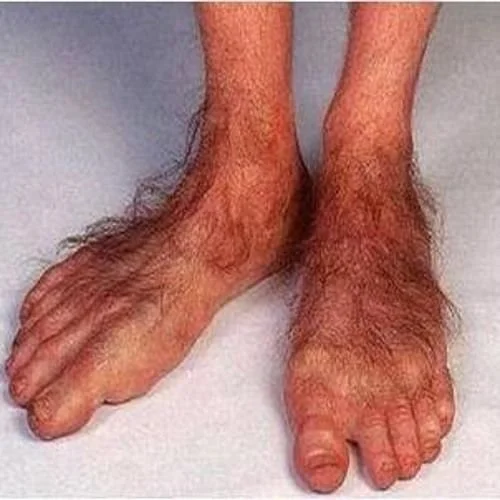 Close-up of a pair of human feet with hairy skin and uneven skin tone, with one foot appearing more swollen and deformed than the other.