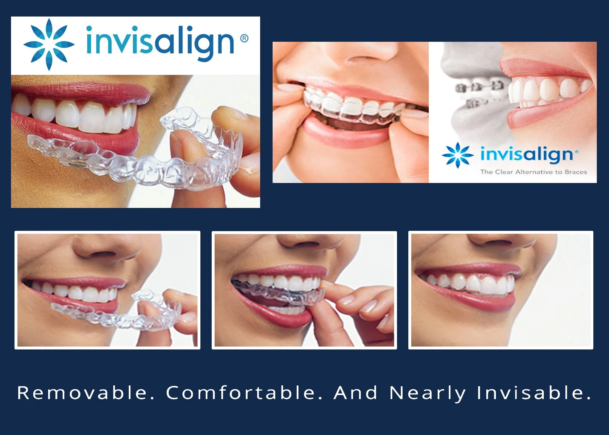 Invisalign Sticking Out At Matthew Mendelsohn Blog