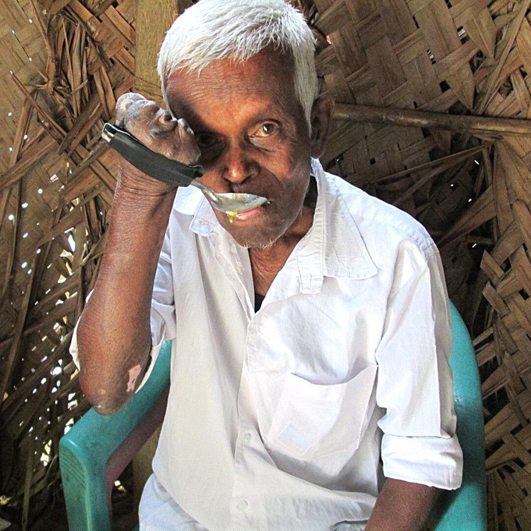 It's #WorldLeprosyDay! Hansen's Disease (also known as leprosy) still occurs in over 120 countries around the globe. Like many of these countries, there are still strong social stigmas surrounding the disease throughout India. 

Send Hope Now support