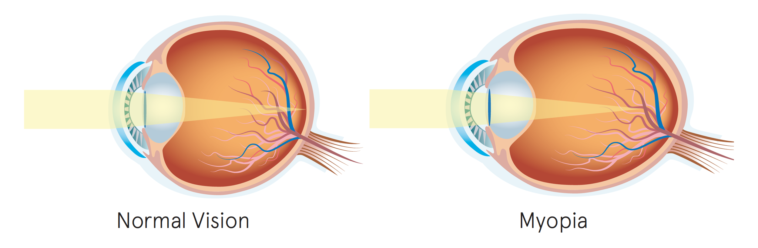 Myopy Myopia Control - All You Need To Know — Eye Academy