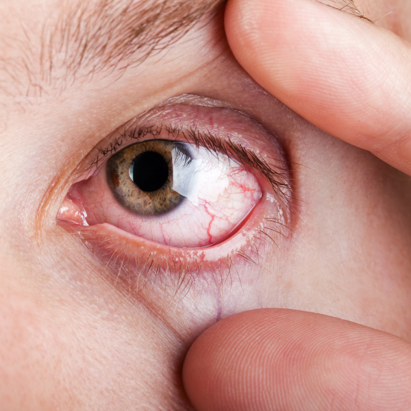 contact lenses for dry eyes