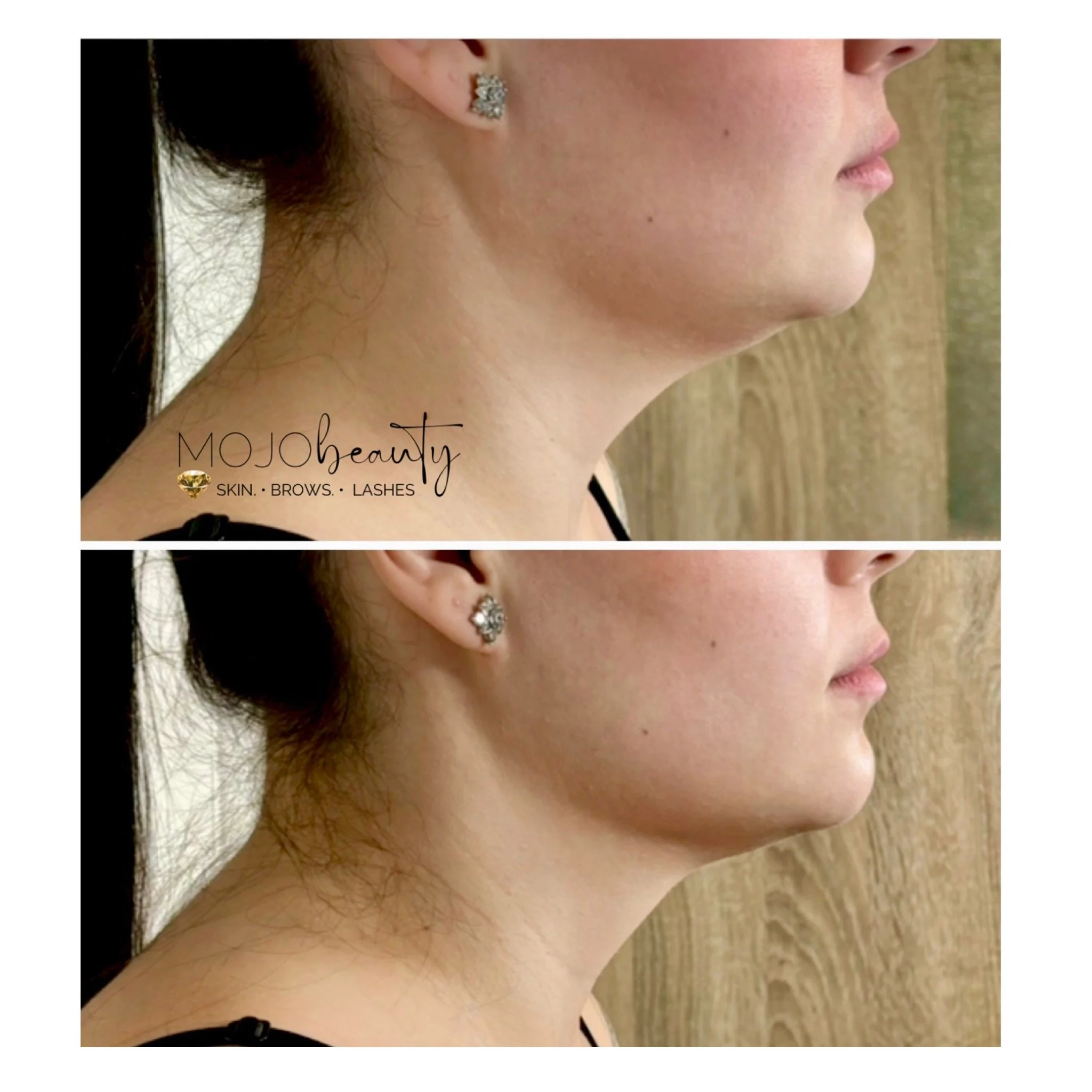 Example of a Jaw Sculpt HIFU treatment at MOJO BEAUTY. This is after only one treatment