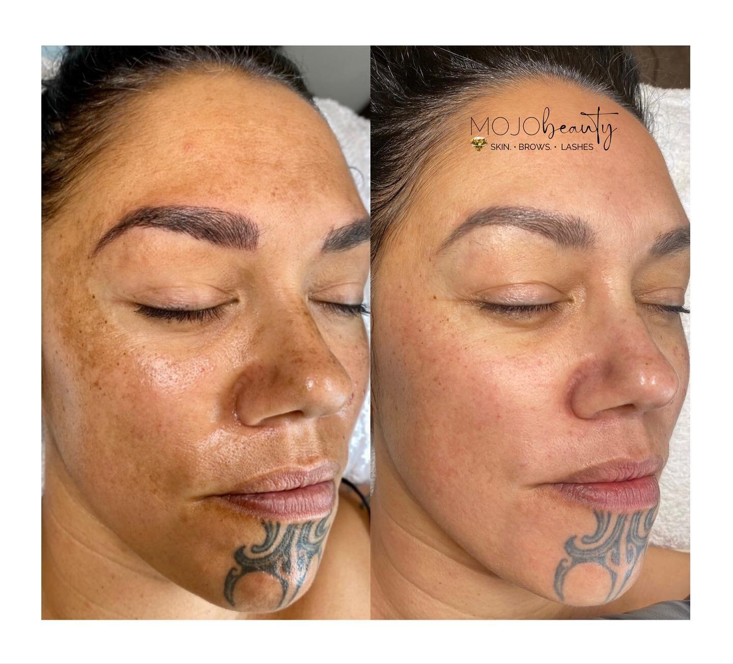 ✨Micro-dermal needling is a method that Nik at Mojo Beauty uses to treat different skin conditions. The technique involves using multiple tiny, sterile needles to puncture the skin causing physical trauma to the skin. This trauma prompts the derma, a