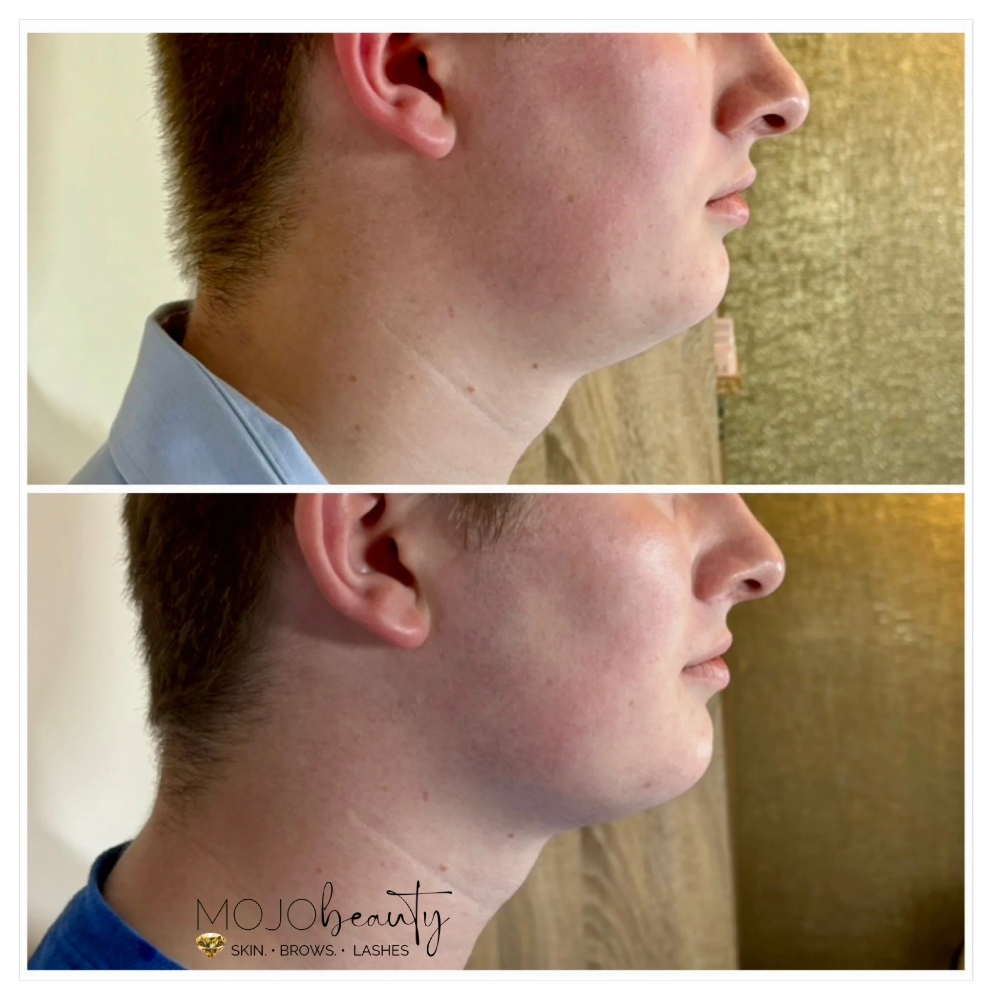 Perfecting a more sculpted jawline for this man through HIFU at Mojo Beauty