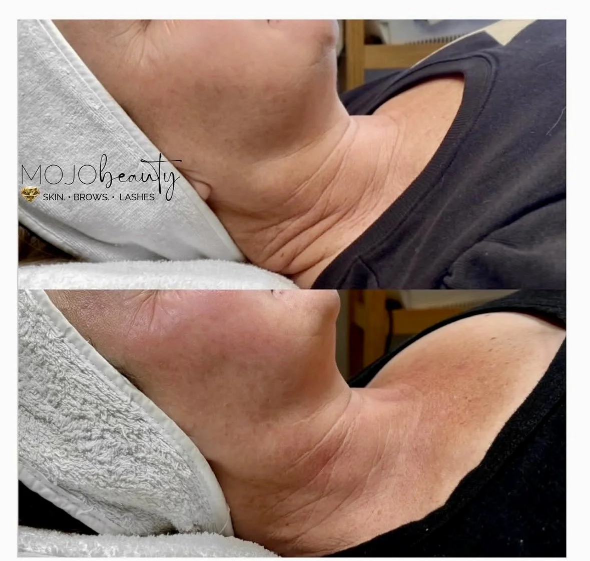 HIFU Neck Sculpt @ Mojo Beauty .jpg