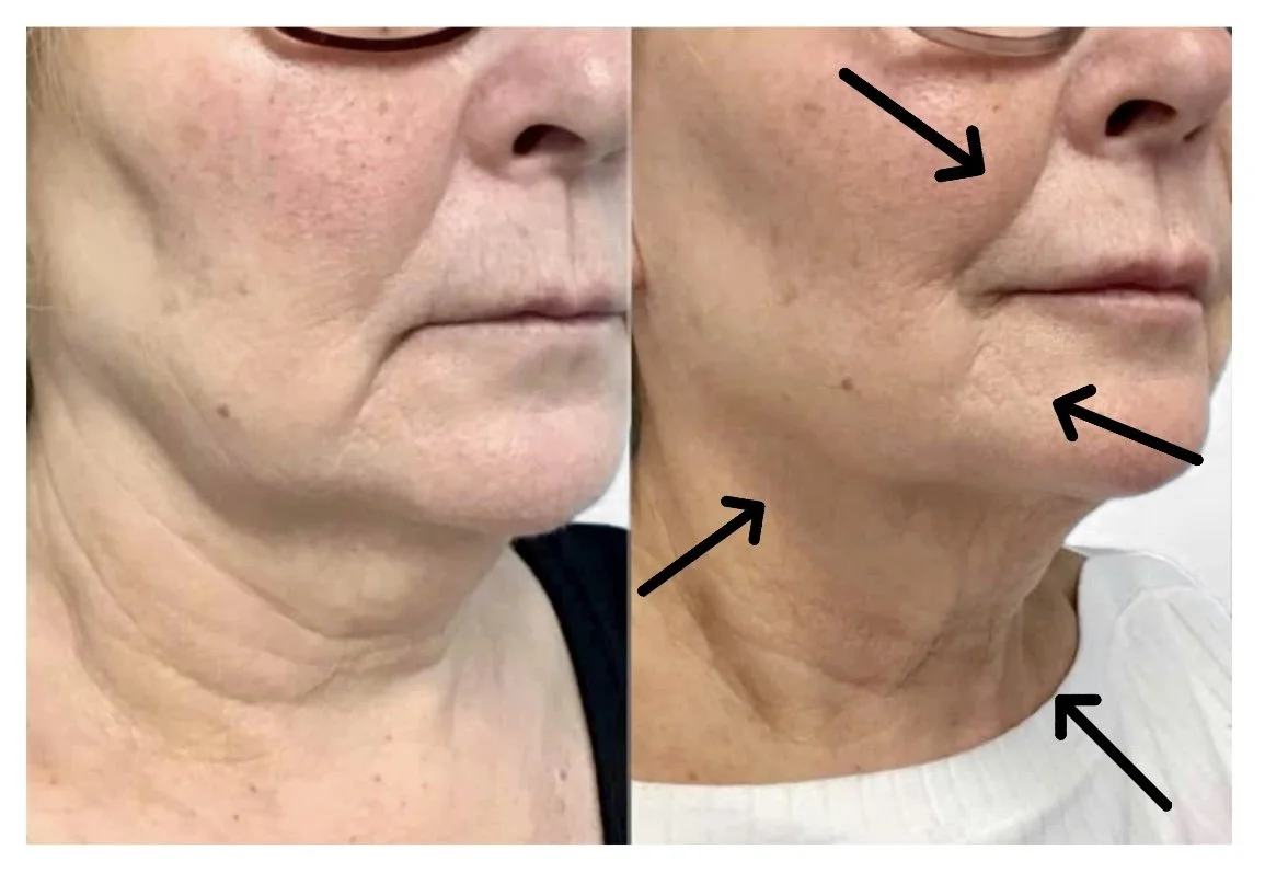 Jowl HIFU Sculpt - Mojo Beauty.jpg