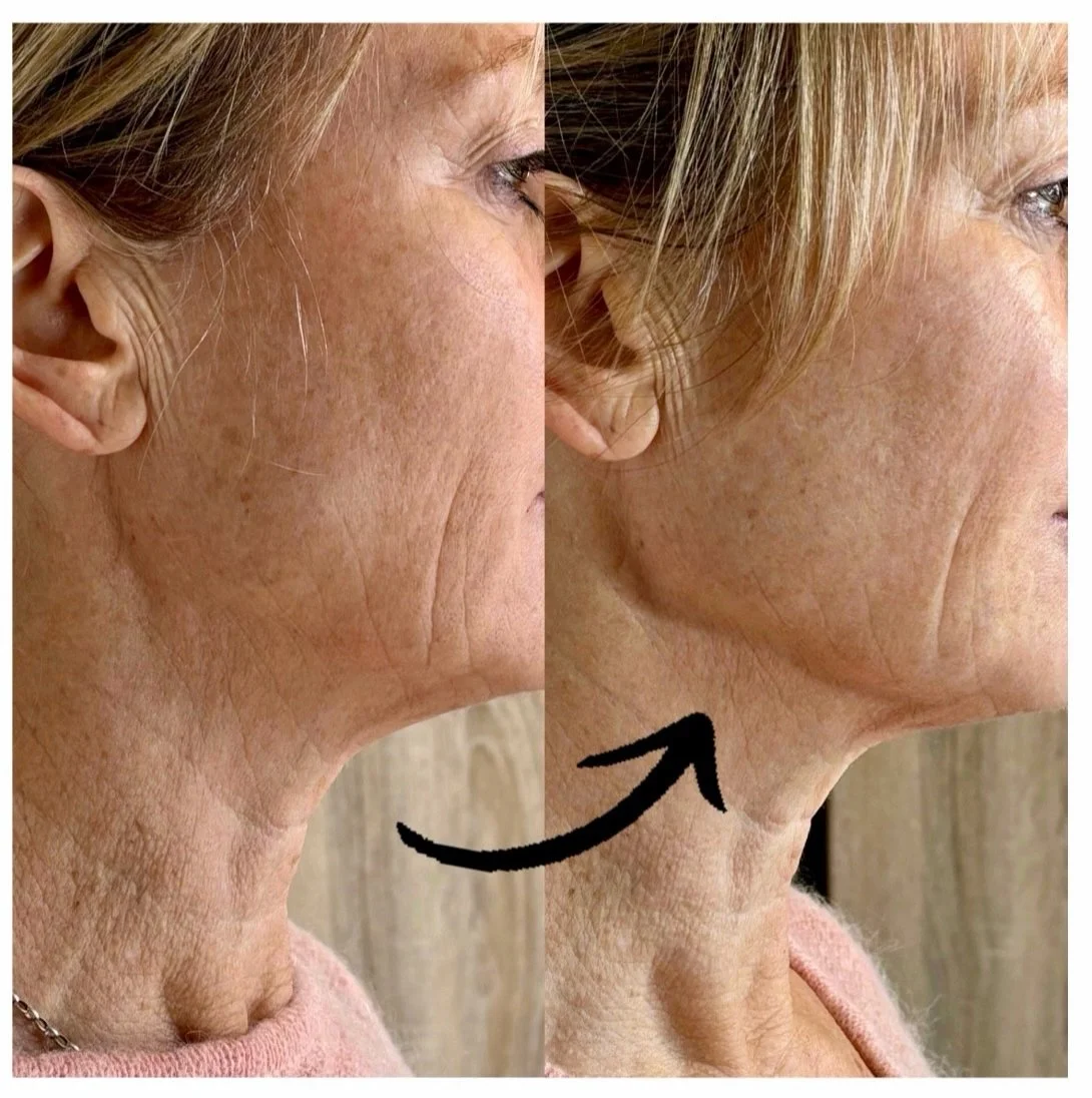 HIFU Jawline before & after @ Mojo Beauty.jpg