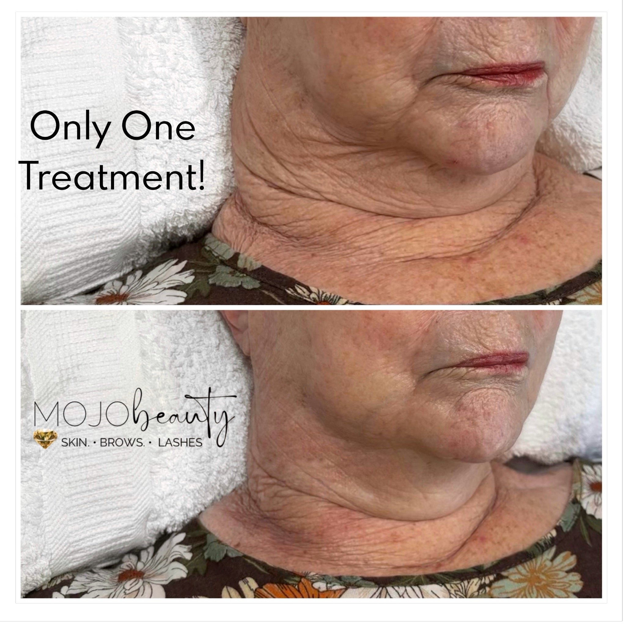 Result of one HIFU at Mojo Beauty.JPG