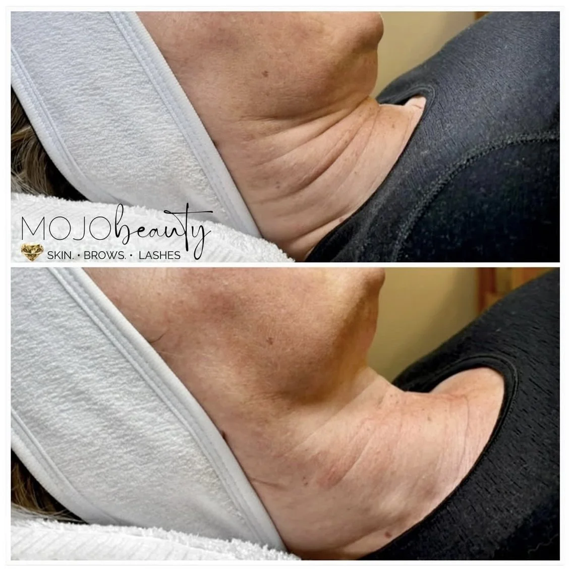 Mojo Beauty HIFU Neck.jpg