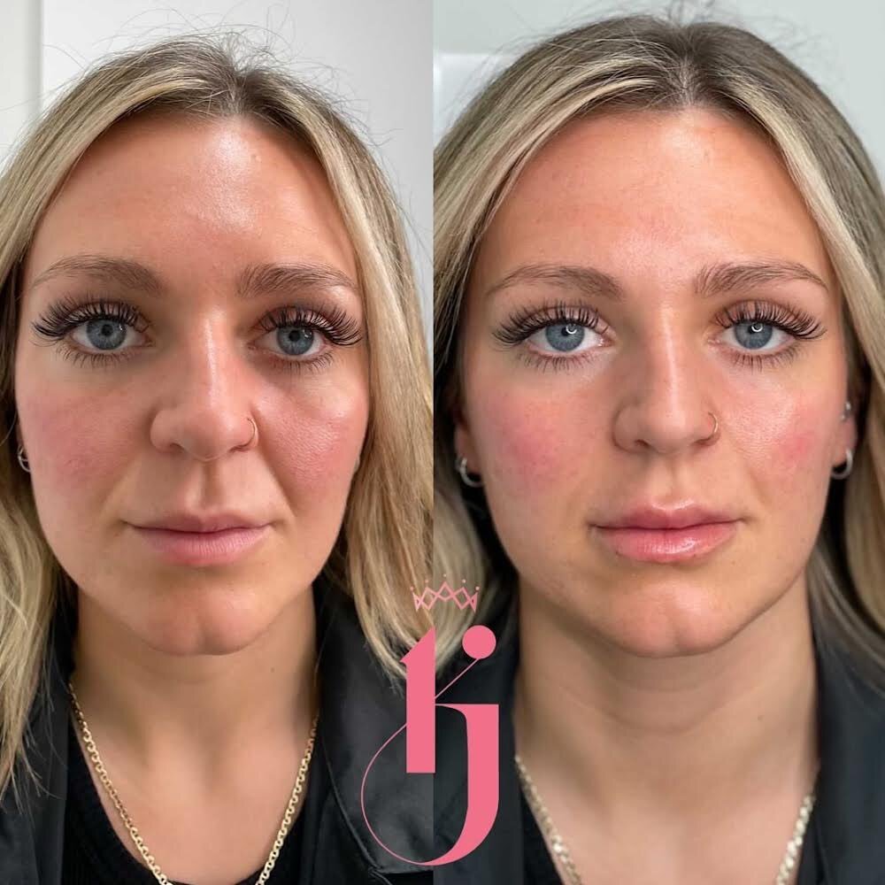 TRILOGY - MIDFACE VOLUME

You can see how restoring subtle volume has lifted the shadows present. Giving you that non-surgical face lift effect. Trust the professionals to look after you!
.
.
.
#Skincare #LipFiller #LipFillers #LipFillerBeforeAndAfte