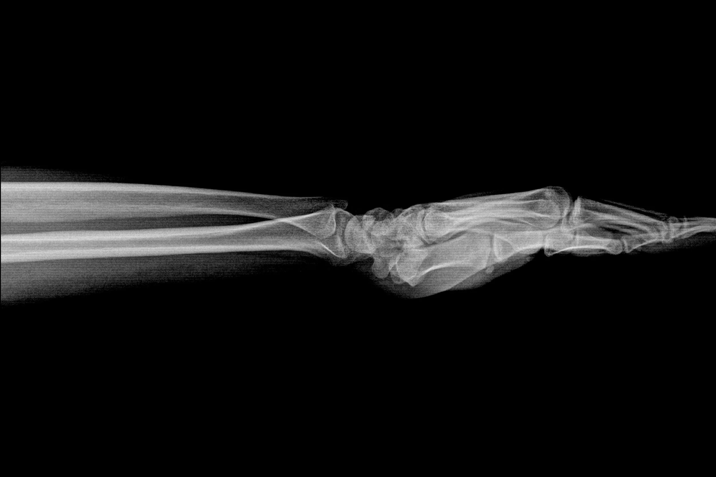 What Maisie Knows an X-Ray Can Reveal - The Bulb Region