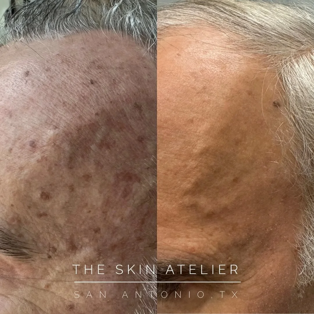 BBL &amp; Moxi, the dream team. This result is after just one session of the combined treatment. We were able to erase years of sun damage in less than an hour. 
Plus, did you know you can treat SKs (seborrheic keratosis) with Moxi? Gone are the days