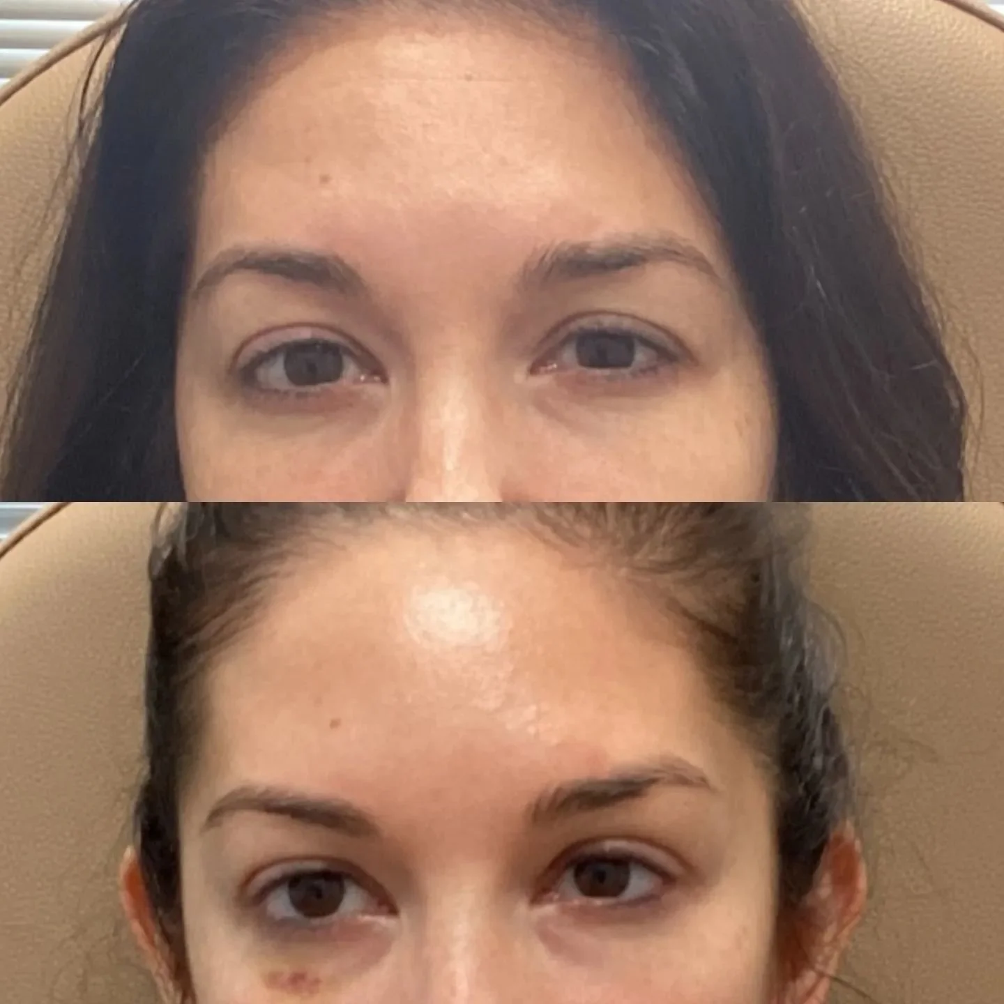 What a difference two weeks can make! This beauty desired more brow symmetry and a lift to her hooded eyelids, especially when smiling. We treated her forehead, in between her brows and around her eyes with @jeuveaubyevolus. 
Today we did a quick fol