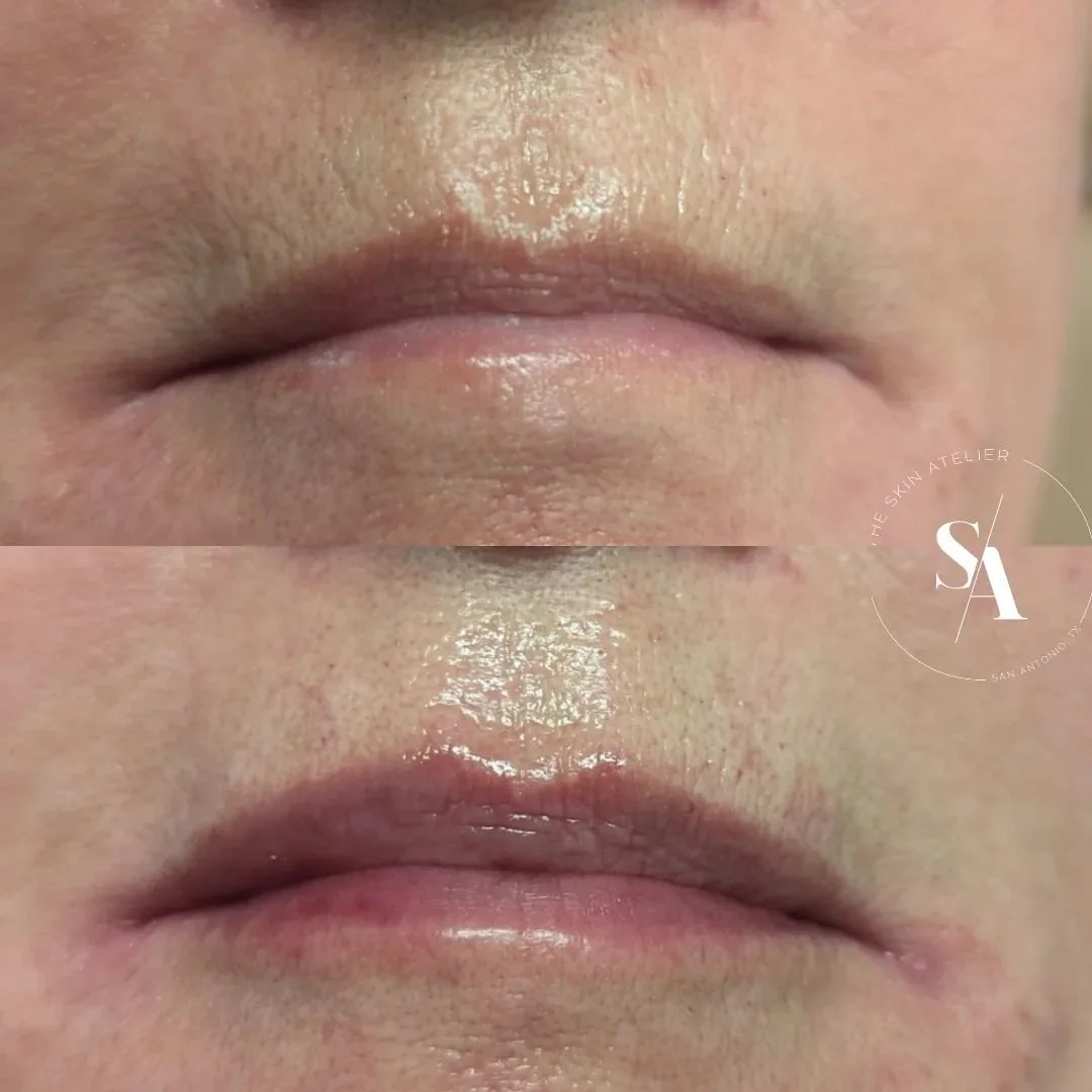 &quot;smokers lines&quot; are one of the most common concerns I hear from my patients. Yes, even from those who don't smoke. My solution for correction almost always involves addressing the lip first. Trust me, I hear you when you say you don't want 