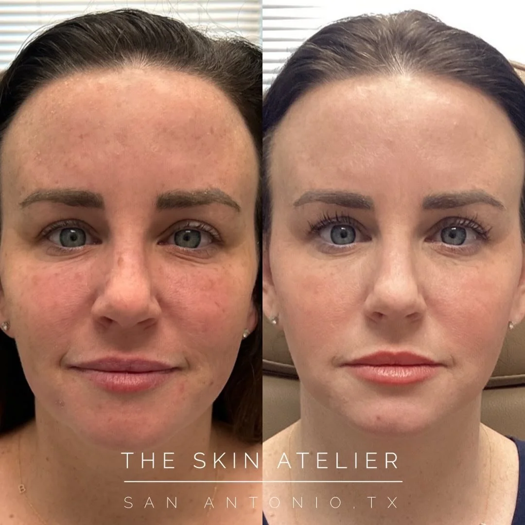 BBL &amp; Moxi strikes again. This combo has quickly become my absolute favorite aesthetic treatment. This result is after just one session. These photos are about two weeks apart and she&rsquo;s wearing just sunscreen in the after. See that dark bro