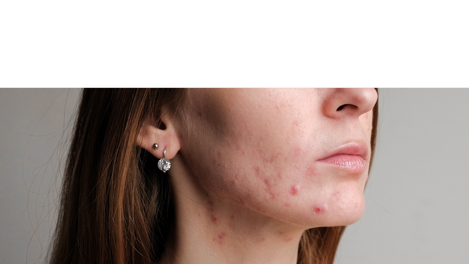Acne Treatment — Skin Revolution Australia