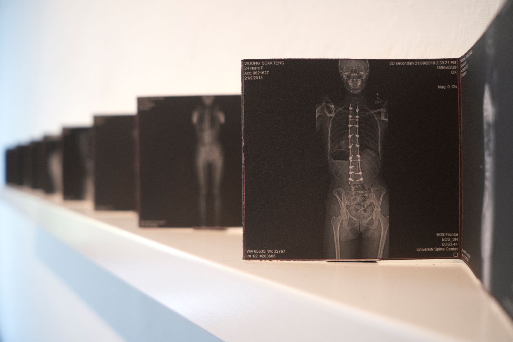  Woong Soak Teng, ‘rules for photographing a scoliotic patient’, 2022, exhibition installation view at Objectifs – Centre for Photography. Image courtesy of the artist. 