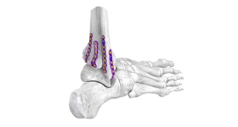 Foot & Ankle medical devices