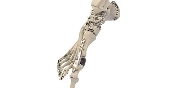 3D patient specific implants