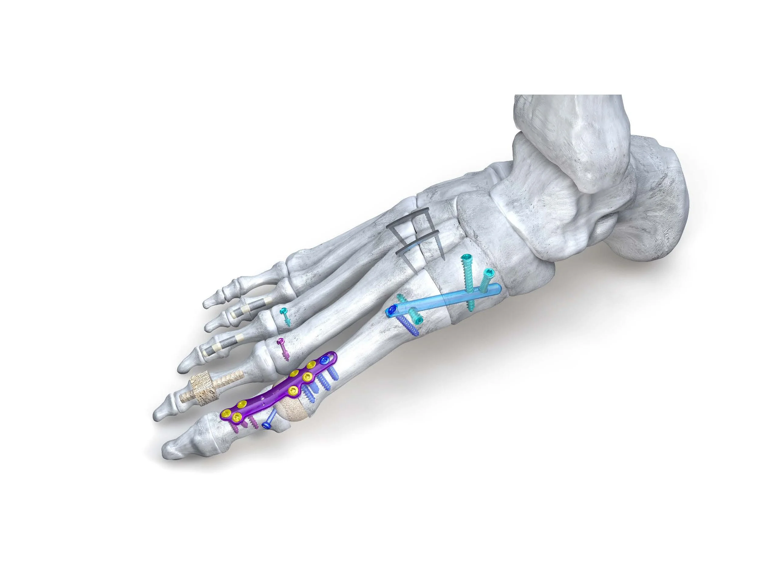Hallux Valgus Arthrodesis repair