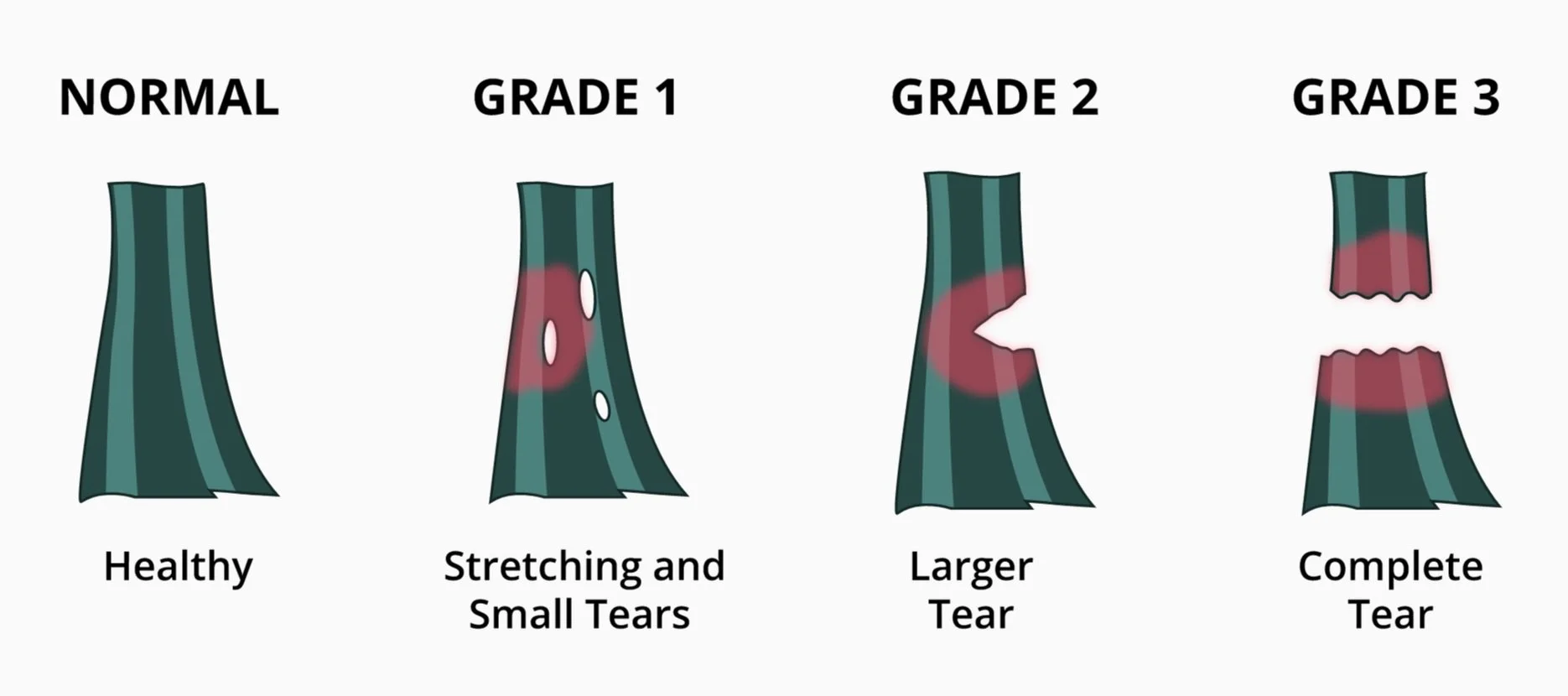 Strained Ligament Muscle Strains vs Ligament Sprains — HealthyHips.ca