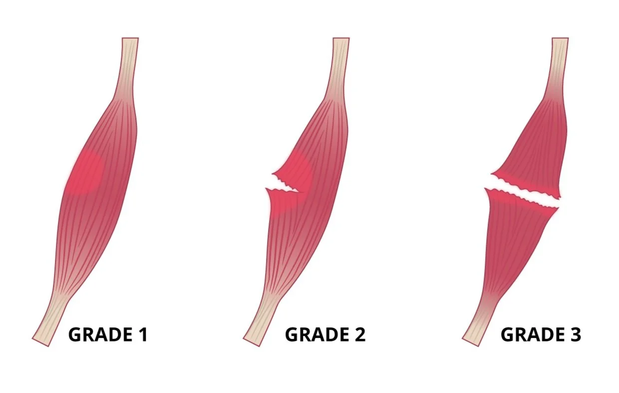 Muscle Strains vs Ligament Sprains — HealthyHips.ca