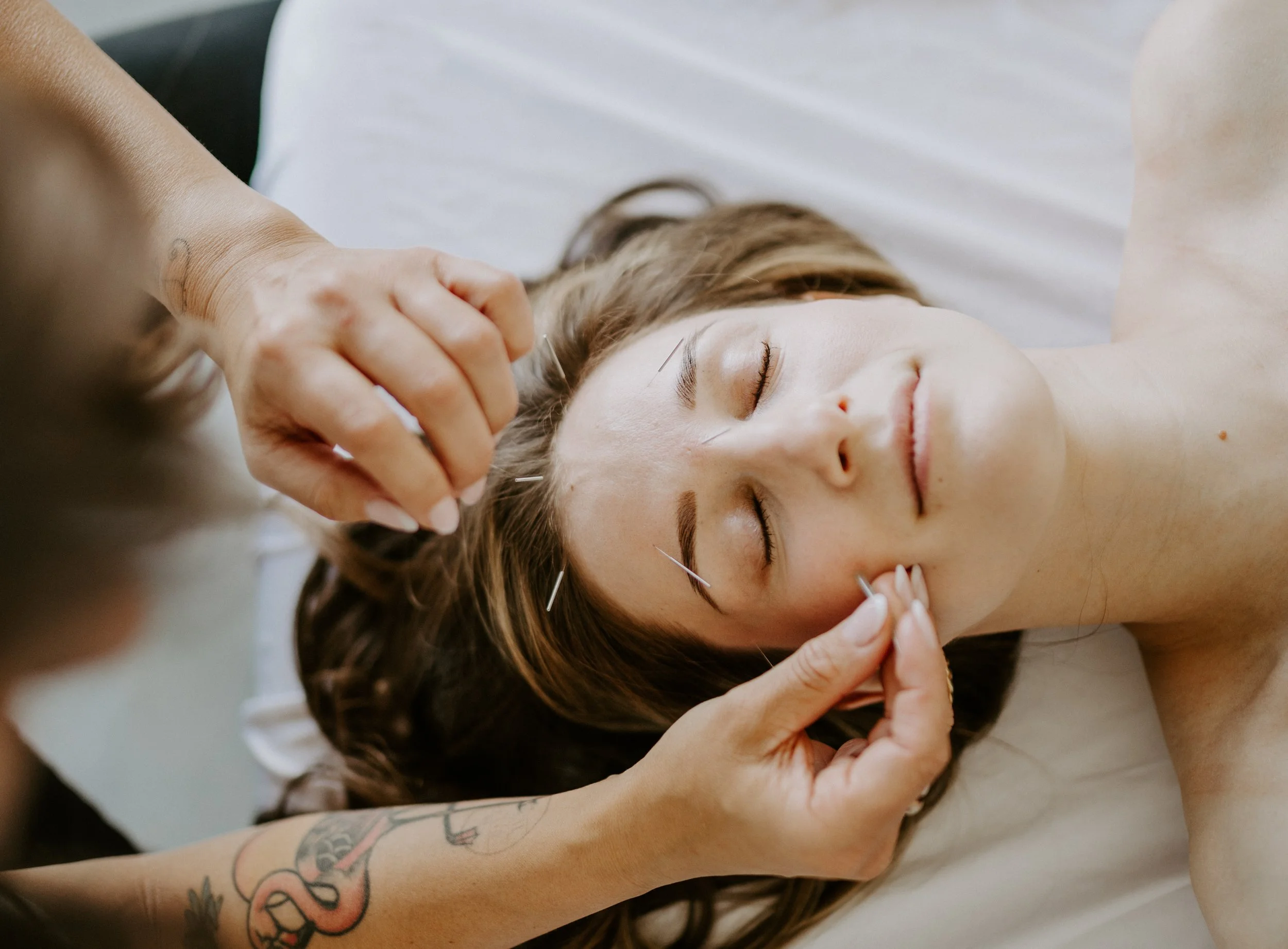 Woman receiving acupuncture treatment on her forehead while lying on a bed with eyes closed.