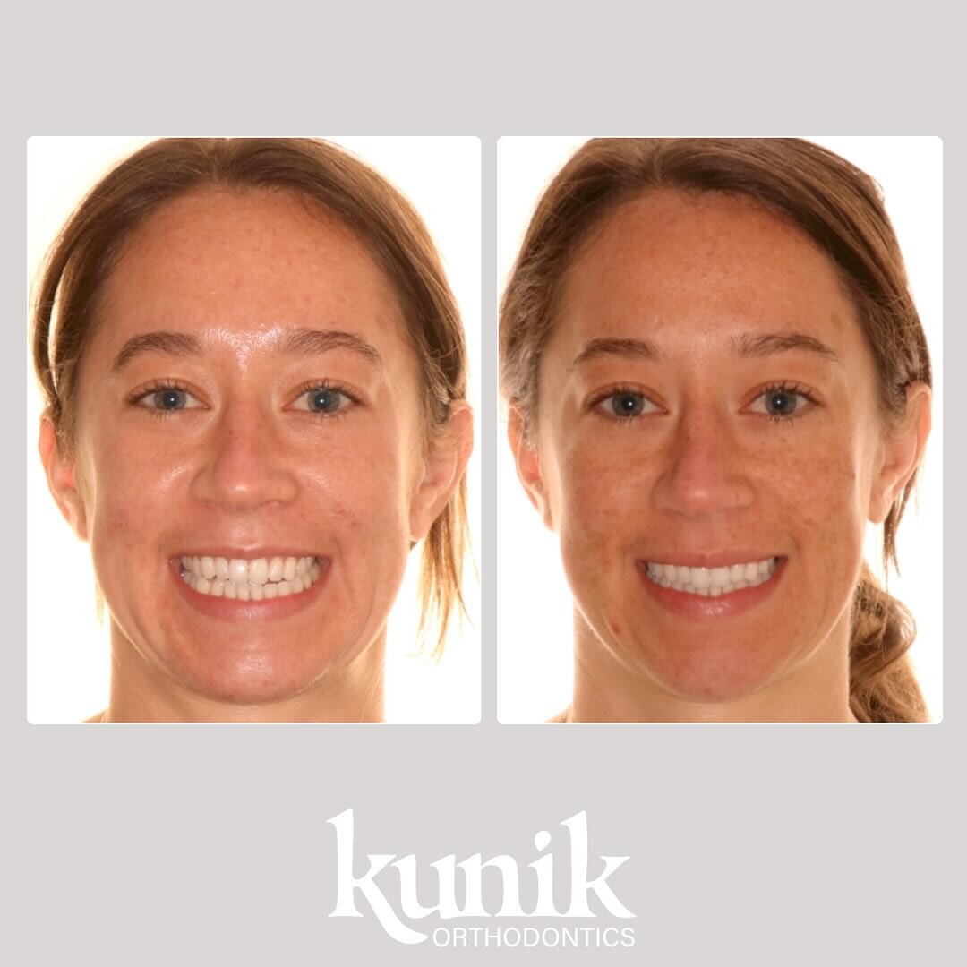 Invisible Braces. Dramatically visible outcome.

This patient had 14 months of upper and lower Invisalign to correct her cross bite and allow her bite to close. 

.

.

#hybrid #braces #invisalign #trend #fyp #ortho #orthodontist #newyear #orthodonic