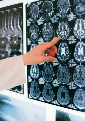 Cerebrolysin, Brain Health &amp; The Future of Cognitive Longevity