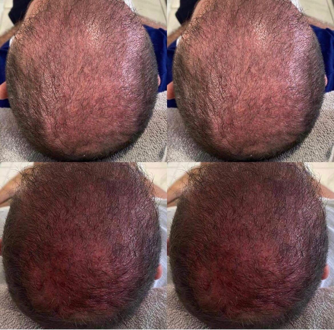 This client came to us post hair transplant for his PRP aftercare. PRP makes grafted hair stronger. It helps the new follicles survive better leading to new hair growth. 
PRP can also be used to treat hair loss/thinning 
#prp #hairtransplant # hairlo