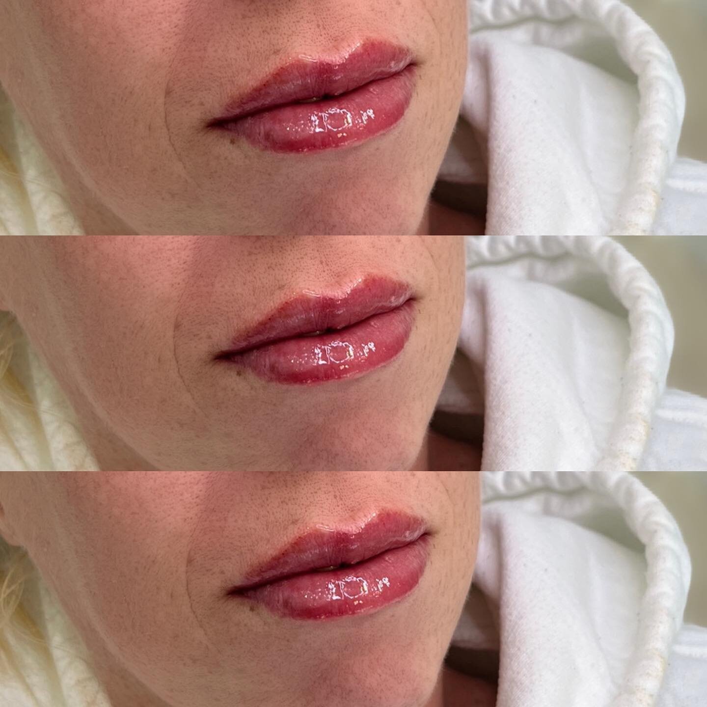 First time lips 

#lipfiller #lipfillersuk #lipfillerbeforeandafter #lipinjections #dermalfillers #dermalfillersnorthernireland #midulster #magherafelt #antiwrinkle
#profhilo #revolax  #fillmed #lip #nurse #loveyourself #cheekfiller #jawfiller #liqui