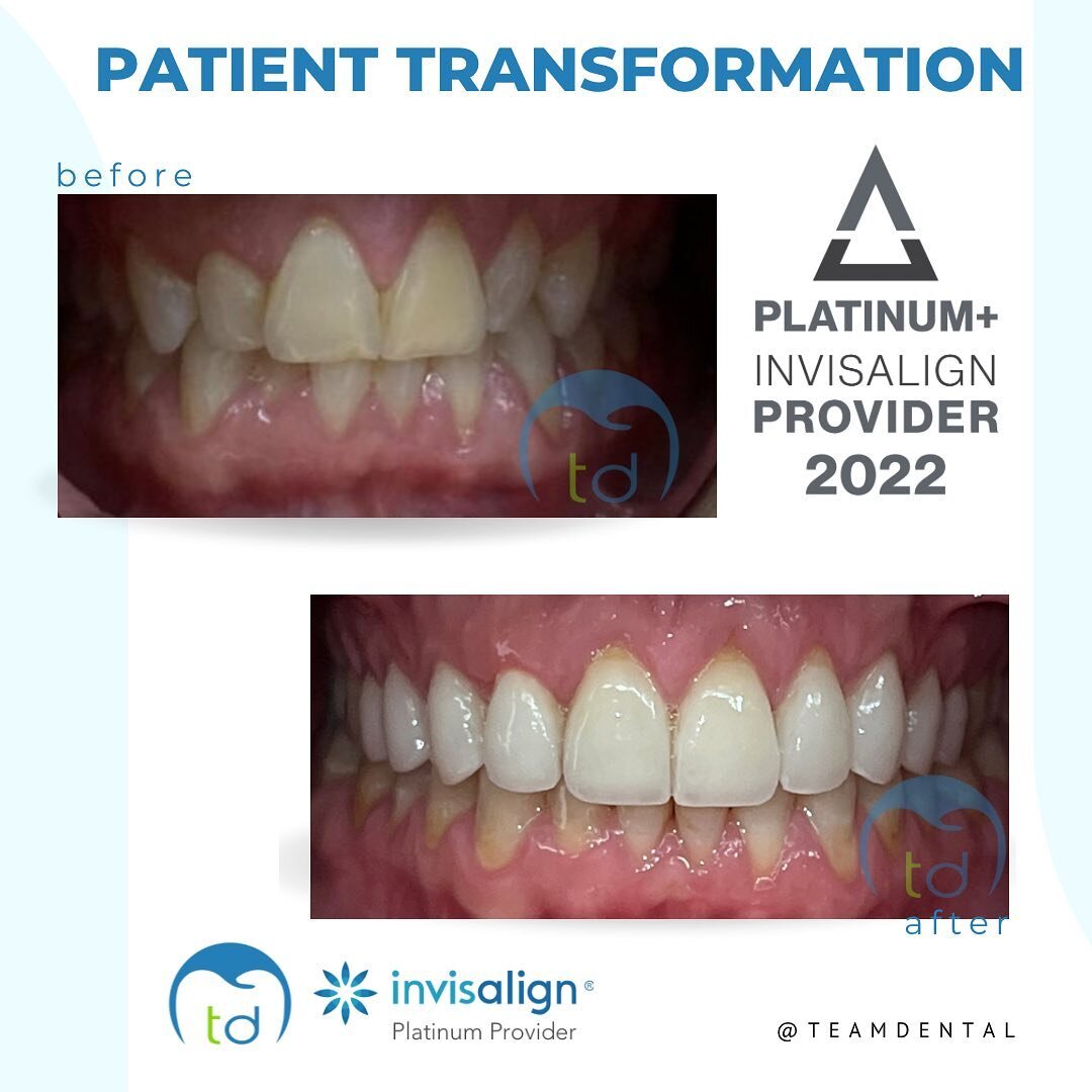 &bull;💥 Check out this before &amp; after on our Invisalign patient. This is an anterior view! Look at the difference. Dr jaffari corrected the bite with invisalign first and did veneers at the end. The results are amazing 🤩 Comment 🫶🏼 if you lov