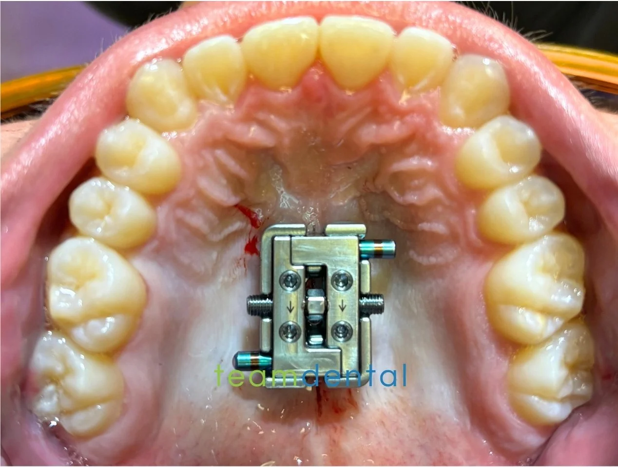Fme Before And After FME, Facegenics, Facegenics Midface Expander, Maxillary Skeletal ...