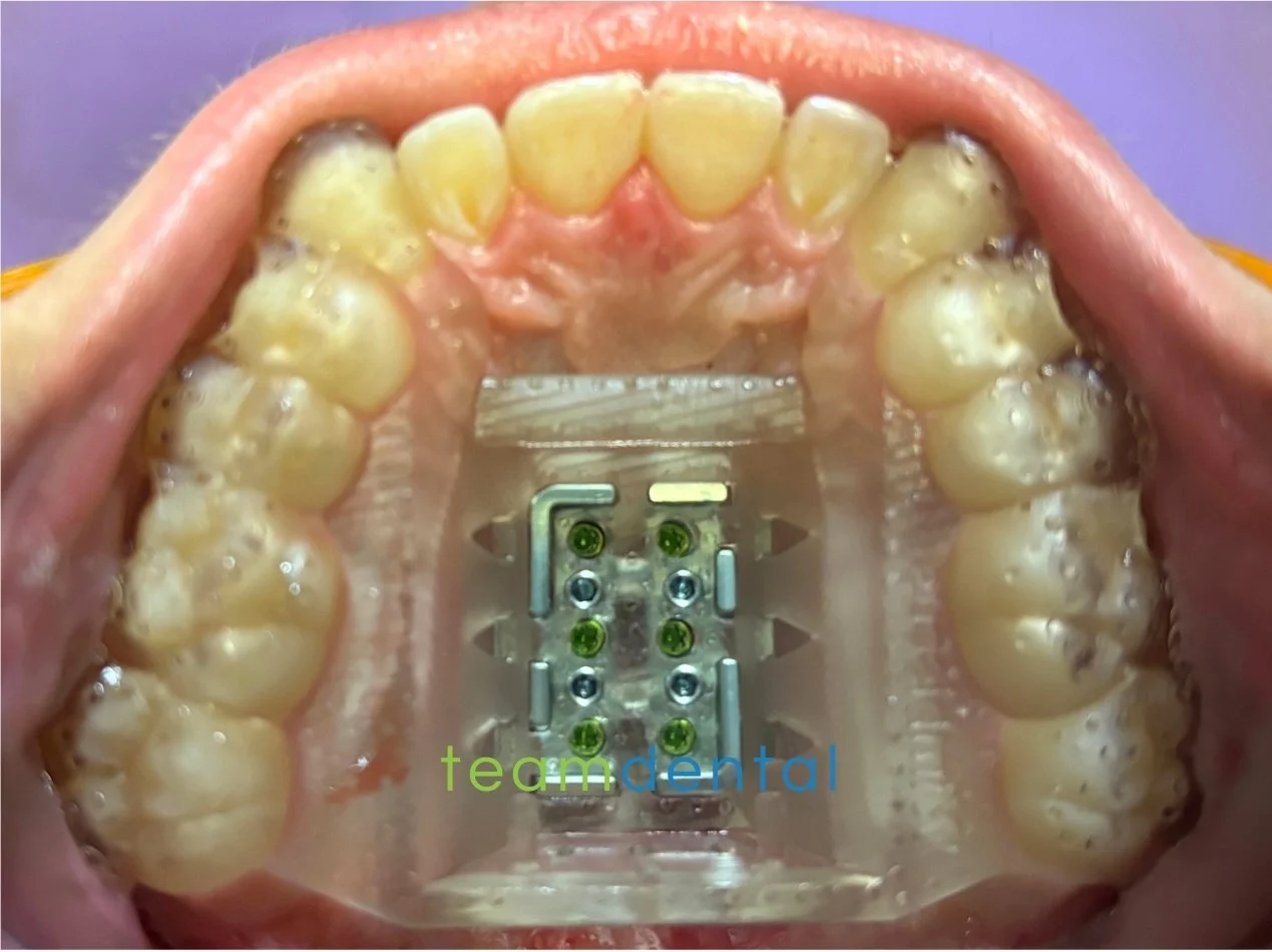 Fme Before And After FME, Facegenics, Facegenics Midface Expander, Maxillary Skeletal ...