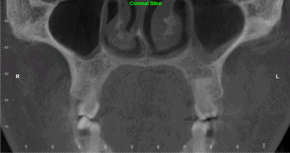 Fme Before And After FME, Facegenics, Facegenics Midface Expander, Maxillary Skeletal ...
