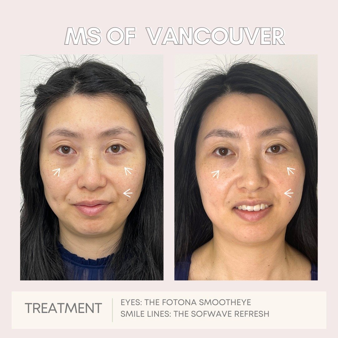 Amazing before and afters with the reigning Ms Of Vancouver @msofvancouver25 , Wendy ✨

To prepare for her upcoming competition at the Ms. Of Canada @misscanadaglobe  in July, Wendy opted for Sofwave Refresh and the Fotona SmoothEye for an instant li