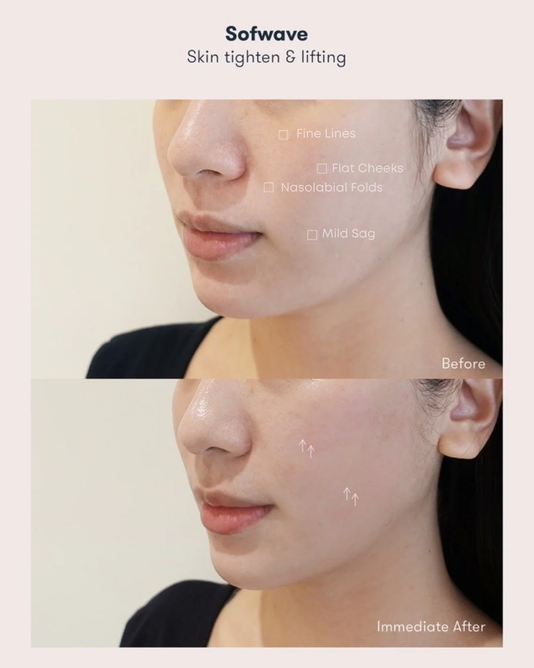 💍 Brides, we see you.

Between dress fittings, seating charts, and last-minute RSVPs, your skin prep may have&hellip; slipped.

✨ Enter Sofwave &mdash; your fairy glam-mother.
✔️ Instant lift &amp; smoothing (hello snatched jawline)
✔️ Zero downtime