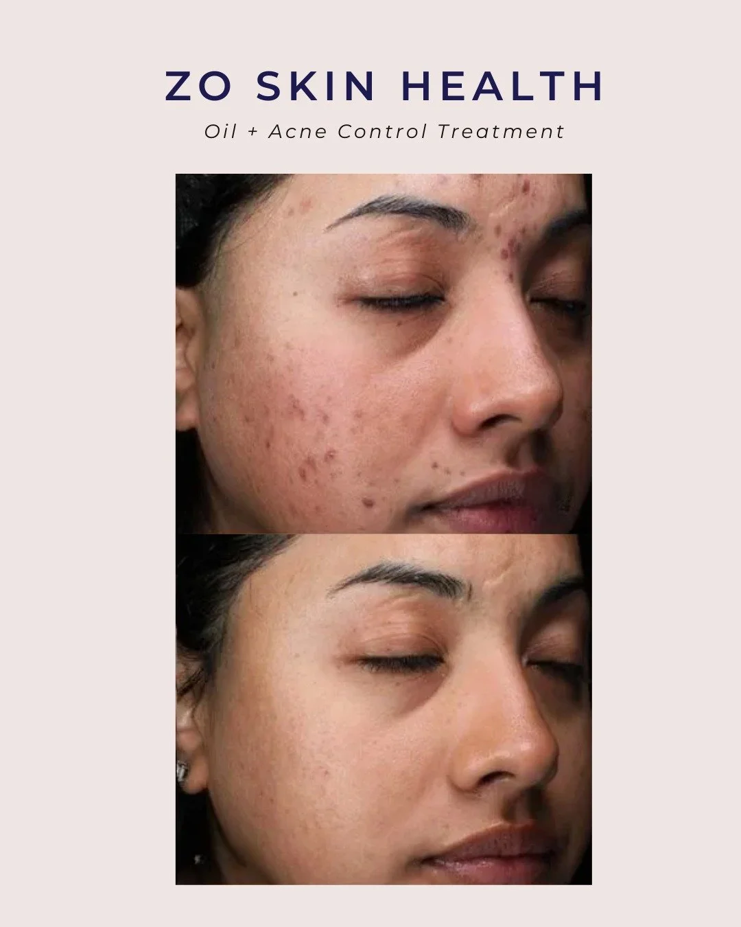 💧 ZO Acne + Oil Control Treatment &ndash; Before &amp; After 💧

This advanced facial targets acne at its source, helping to reduce blemishes, control oil production, and improve overall skin texture. 

Book a complimentary consultation to learn mor