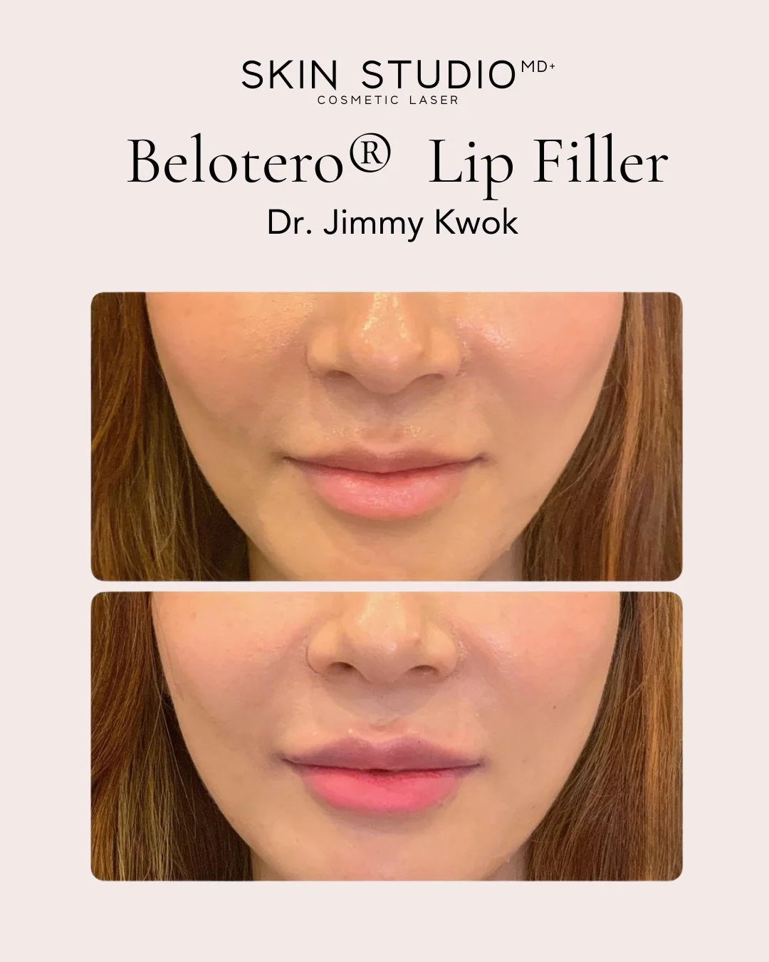 💋 Lift &amp; Define with Belotero&reg; - Results by Dr. Jimmy Kwok 

It&rsquo;s not always about &ldquo;more&rdquo;&mdash;sometimes it&rsquo;s about refinement. The natural M-shape of the lips is what gives them elegance and balance, and with Belote