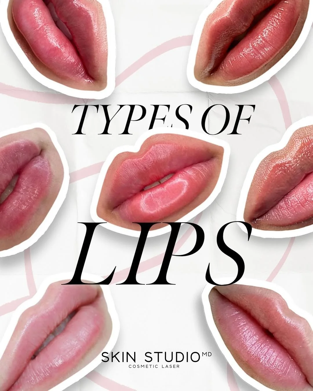 Pucker up! From a more defined Cupid&rsquo;s Bow to fuller and juicer lips, we&rsquo;ve got you covered! 👄

#LipFillers can be done by our skilled and trained SSMD injector, Dr. Jimmy Kwok

 💋 Send us a direct message to book a consultation!