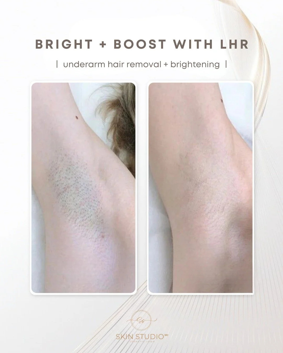 ✔️Hair? Gone.
✔️Dark Spots? Gone.
✔️Bumps? Gone.

🌟 Our Bright + Boost treatment uses PICO and long pulse energy to improve underarm hyperpigmenttaion and effectively treat chicken skin and visible lines.

Paired with Laser Hair Removal, this is you