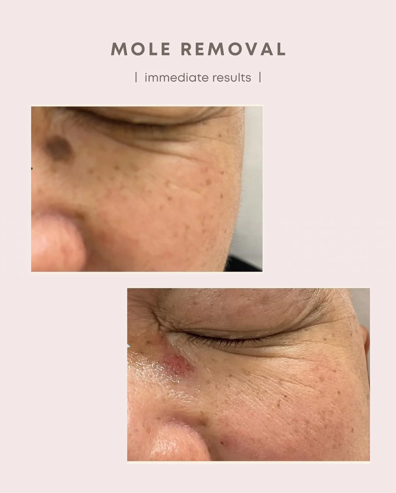 Gone in minutes 👋🏻

Sometimes the smallest changes make the biggest difference. Our client&rsquo;s mole removal was quick, comfortable, and completely safe✨