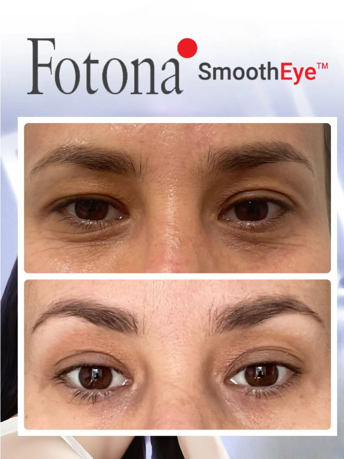 The Non-Surgical Eye Lift You&rsquo;ve Been Waiting For ✨

Tired eyes? Heavy lids? Fine lines that concealer just can't hide?

Our Fotona SmoothEye&reg; treatment is a game-changer for those seeking a refreshed, youthful look without the needles or s