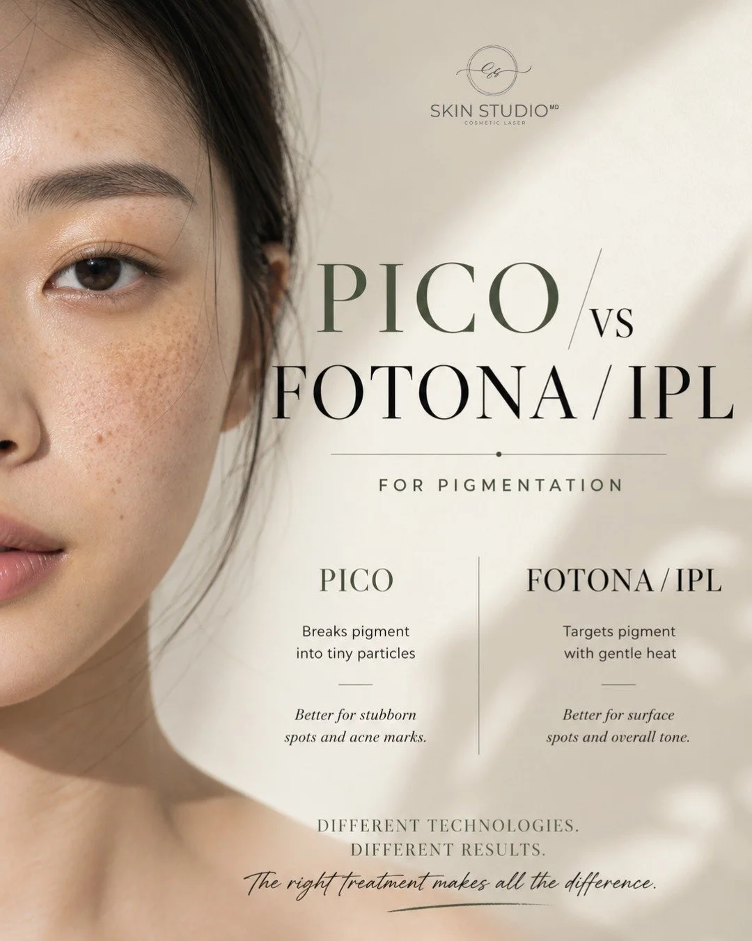 If your pigmentation keeps coming back and refuses to budge&hellip;

read this 👇

Most people think:
&ldquo;I just need more sessions&rdquo;

No.

You need the RIGHT type of treatment.

🔥 IPL / Fotona
&rarr; uses heat to break down pigment
&rarr; g